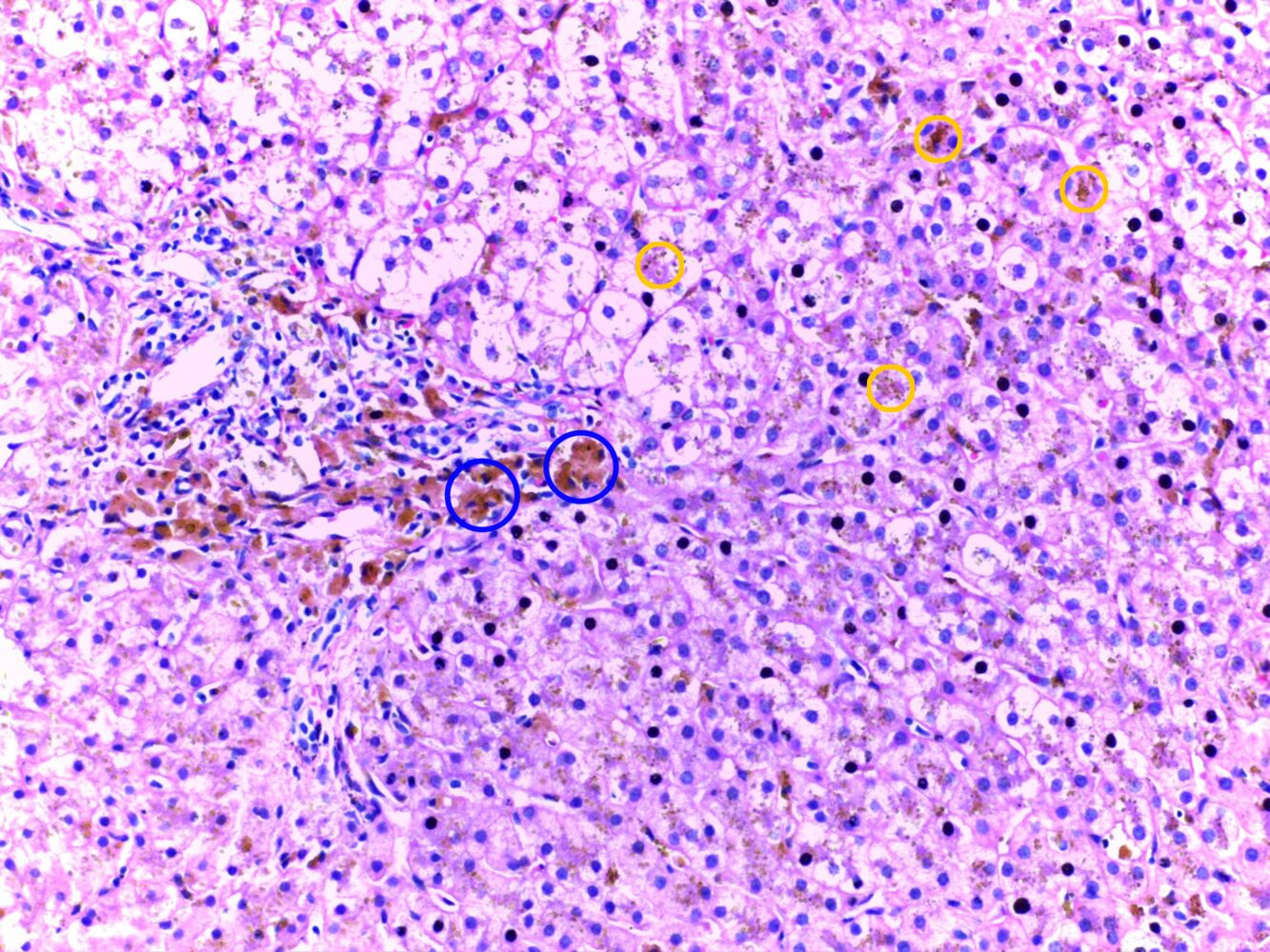 Hemokromatosis herediter