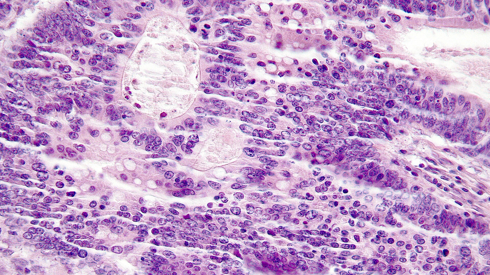 kolorektal non-poliposis herediter